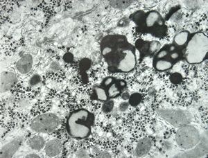 M,15y. | Wilson disease susp.